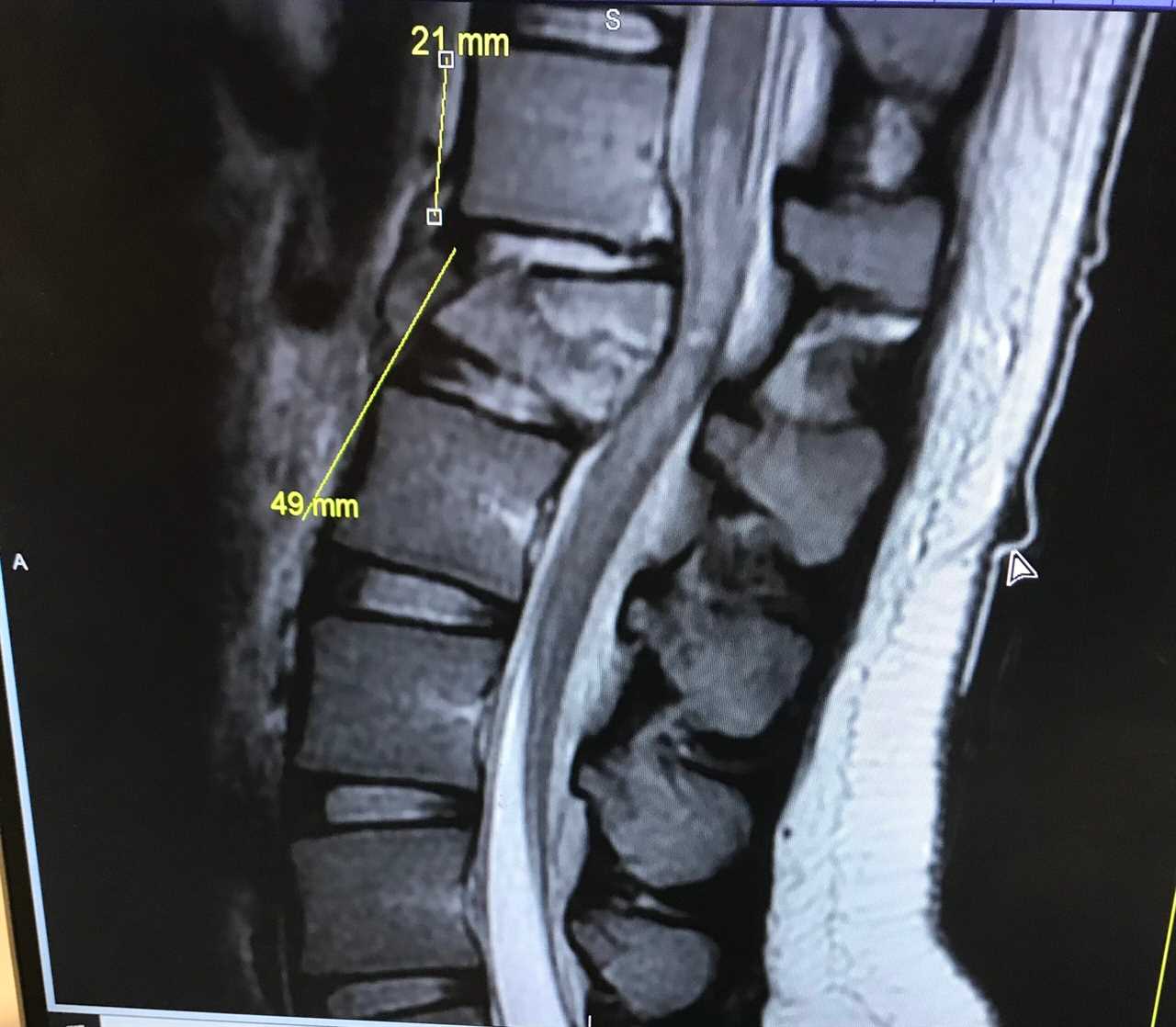 Cynthia Wiford broken back